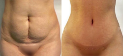 Tummy Tuck before and after photo