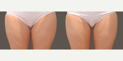 CoolSculpting before and after photo