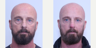 Eyelid Surgery before and after photo