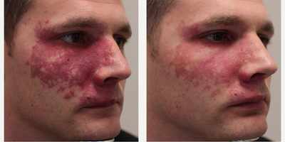 Laser Resurfacing before and after photo