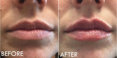 Lip Fillers before and after photo