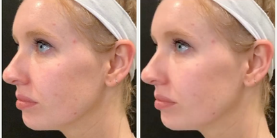 Morpheus8 before and after photo