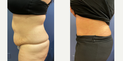 Tummy Tuck before and after photo