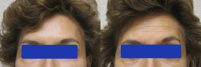 Botox before and after photo