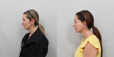 Facelift Revision before and after photo