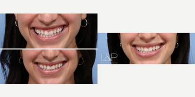Botox before and after photo