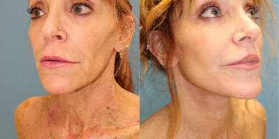 Facelift before and after photo