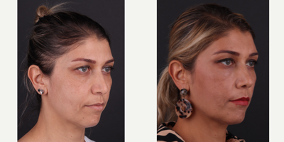 Facial Fat Transfer before and after photo