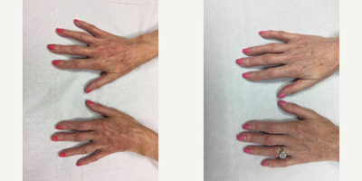Hand Rejuvenation before and after photo