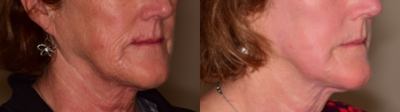 Laser Resurfacing before and after photo