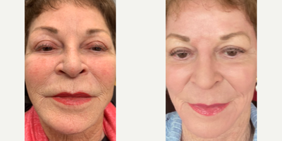 Laser Resurfacing before and after photo