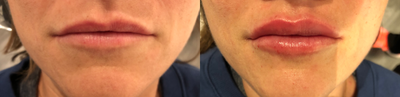 Lip Fillers before and after photo