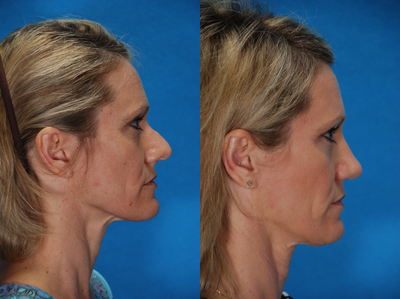 Revision Rhinoplasty before and after photo