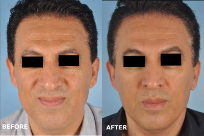 SMAS Facelift before and after photo
