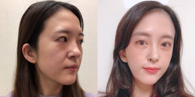 Canthoplasty before and after photo