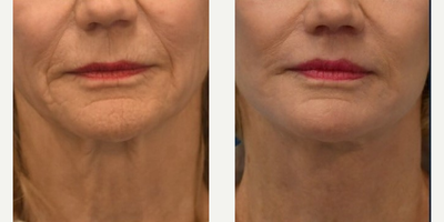 CO2 Laser before and after photo
