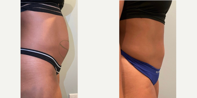 CoolSculpting Elite before and after photo