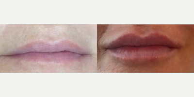 Dermal Fillers before and after photo