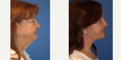 Eyelid Surgery before and after photo