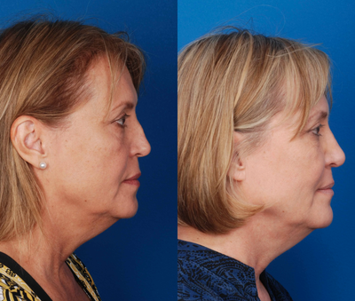 Rhinoplasty before and after photo