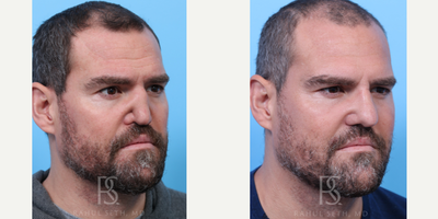 Rhinoplasty before and after photo