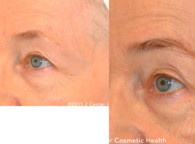 Ultherapy before and after photo