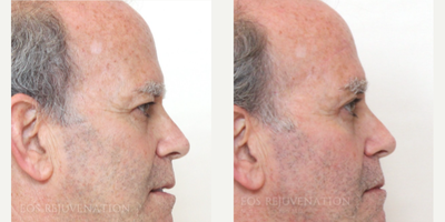 Brow Lift before and after photo