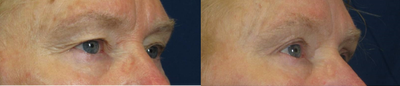 Eyelid Surgery before and after photo