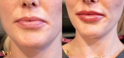 Juvederm before and after photo