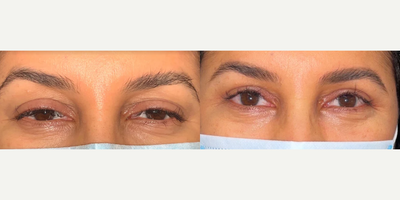 Ptosis Surgery before and after photo