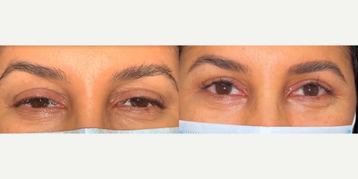 Ptosis Surgery before and after photo