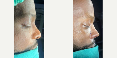 Revision Rhinoplasty before and after photo