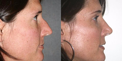 Rhinoplasty before and after photo
