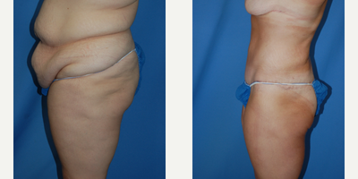 Tummy Tuck before and after photo
