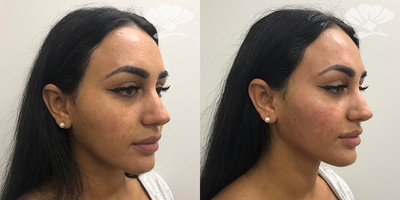 Chin Filler before and after photo