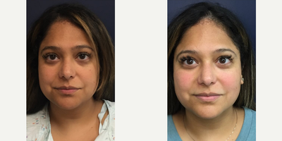 Ultherapy before and after photo