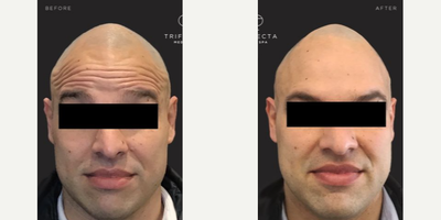 Botox before and after photo
