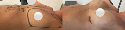 Breast Augmentation before and after photo
