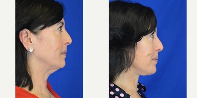 Eyelid Surgery before and after photo
