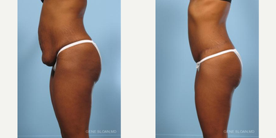 Tummy Tuck before and after photo