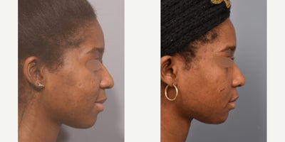 African American Rhinoplasty before and after photo