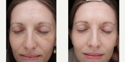 Chemical Peel before and after photo