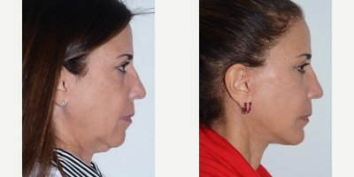Deep Plane Facelift before and after photo