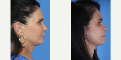 Facelift Revision before and after photo