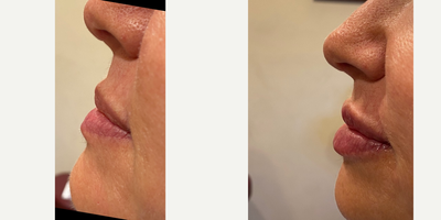 Juvederm before and after photo