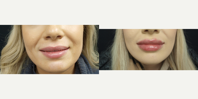 Lip Fillers before and after photo