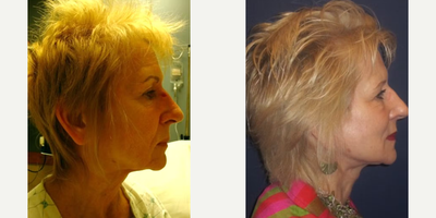 Neck Lift before and after photo