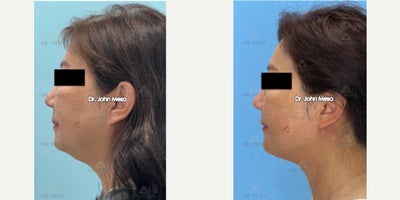 Neck Lift before and after photo