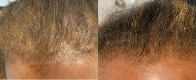 PRP Injections before and after photo