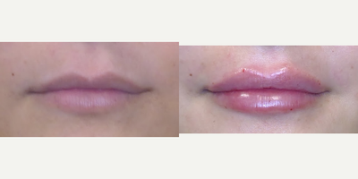Dermal Fillers before and after photo